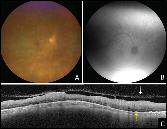 Figure 1. A 67-year-old female presented with blurred vision for 1 year and her symptoms were initially treated as uveitis without improvement