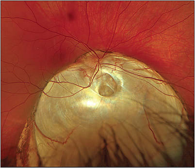 Optos color RGB image of a 30-year-old female with an inferior choroidal coloboma. Vision was 20/200. Image courtesy of Retina Rocks.