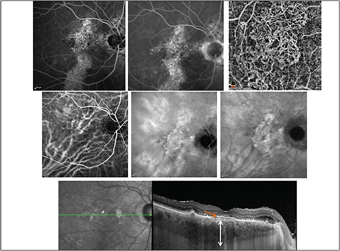 Figure 2. Chronic central serous chorioretinopathy with diffuse epitheliopathy. Image A shows a 69-year-old male with 70% vision in the right eye. Spectral-domain OCT showed thick choroid with pachyvessels, subfoveal flat irregular pigment epithelium detachments (FIPEDs), subtle retrofoveal SFR and schizoid intraretinal fluid temporal to the optic disc; FA showed extended gravitational tacks of RPE pigment loss superior, inferior, and nasal to the macula. Indocyanine green (ICG) angiography showed hyperpermeable pachyvessels on midphase ICG and an hypercyanescent plaque in the late phase of ICG. The OCTA images of the choroidal vessels confirmed the presence of choroidal neovascularization without the FIPED.