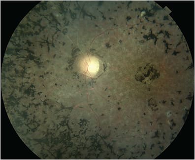 Figure 1. The typical end-stage retinitis pigmentosa retinal phenotype demonstrating bone-speculated hyperpigmentation, retinal vascular attenuation, and optic disc pallor. The disease primarily affects cells of the outer retina (photoreceptors and retinal pigment epithelium) with relative preservation of the inner retina such as retinal ganglion cells.