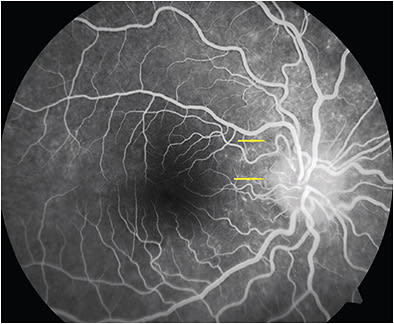 Figure 2. Dots showing punctate hyperfluorescence starting in the early phase and extending into the arterial phase nasal to macula and close to the disc (yellow arrows). Reprinted with permission from Chandrasekaran PR, Kerala J Ophthalmol. 2021;33(2):214-216. DOI:10.4103/kjo.kjo_14_21