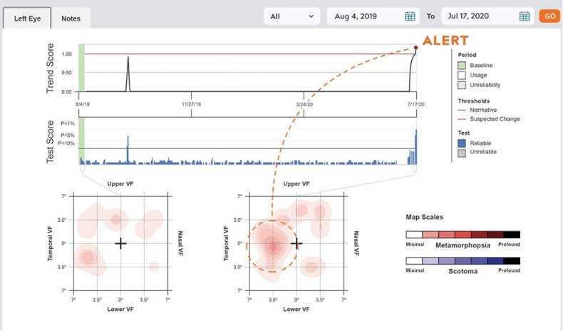 Figure 1. Patient metamorphopsia map and testing data from the ForeseeHome portal.