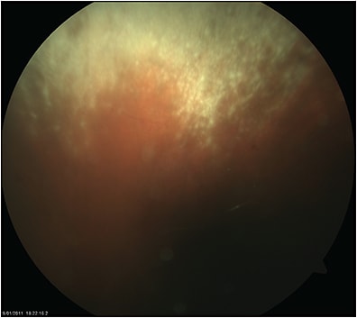 Figure 7. Granular cytomegalovirus retinitis in the peripheral retina. FIGURE REPRINTED WITH PERMISSION FROM ELSEVIER.1