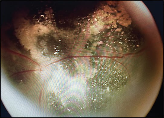 Figure 1. This 4-month-old baby, born at 28 weeks, presented to Bascom Palmer Eye Institute for surgical evaluation. The eye had received no treatment and the retina was completely detached. (The fellow eye had undergone surgery in the Caribbean region, and silicone oil remained in that eye.) Shown here is the eye 6 months after pars plana vitrectomy and lensectomy. Two years after the procedure, the child had maintained light perception.