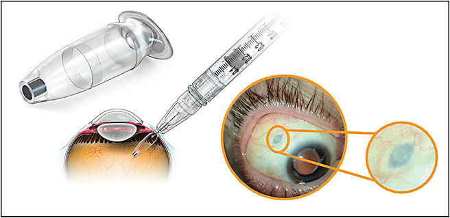 Figure 3. The ranibizumab port delivery system (Genentech).