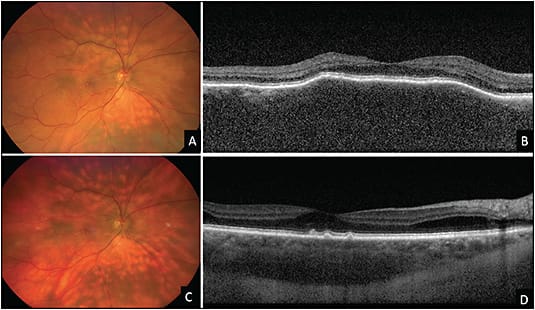Figure 3. A 58-year-old male patient presented with a 4-month history of blurred and distorted vision in the right eye. Fundus examination of the right eye revealed multifocal diffuse choroidal infiltration (A).