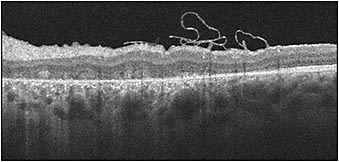 Figure 2. Closed traumatic macular hole in a 22-year-old patient following surgical repair with the inverted ILM flap technique.