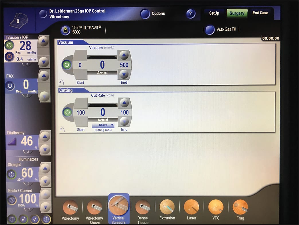 Figure 2. Vertical Scissors Preset &#8211; A low cut rate is used to simulate vitrectomy-console-driven vertical scissors. In conjunction with the smaller port diameter of MIVI, a low cut rate allows for the selective removal of epiretinal tissue under low-vacuum, controlled conditions.