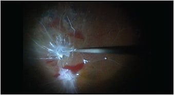 Figure 3. The tissue plane has been defined proximal to the superotemporal arcade, and the vitrectomy probe is used as a vertical scissors to segment foci of fibrovascular proliferation. Excision of epiretinal proliferative tissue is achieved via alternating among aspiration-delamination, dissection, and excision via the small-gauge vitrectomy probe, in analogy to alternating use of forceps, blunt pick, and vitrectomy cutter.