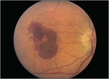 Figure 1. Fundus photograph of a right eye with new submacular hemorrhage from neovascular macular degeneration.