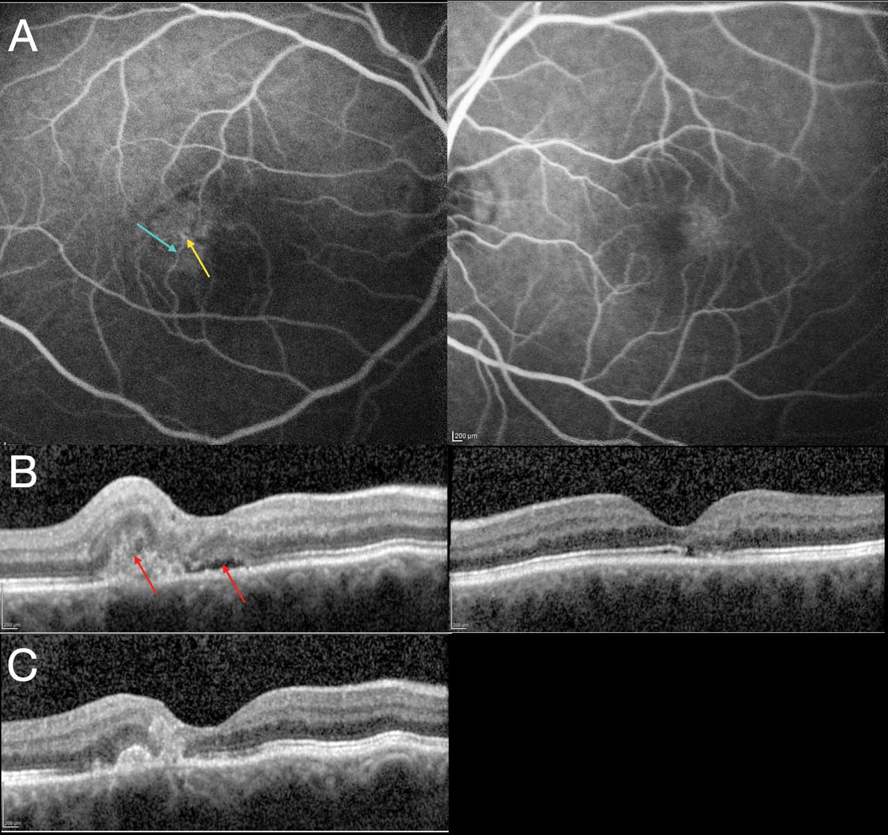 Figure 3.  Fluorescein angiography and optical coherence tomography of a patient with neovascular macular telangiectasia. Yellow arrow highlights an aneurysmal vascular change; blue arrow shows a proximal anastomosis (A). On optical coherence tomography imaging, there is new subretinal fluid with intraretinal disorganization (most probably indicated intraretinal fluid) out of proportion to what is found in the contralateral eye (B). After the patient is treated with anti-VEGF injection