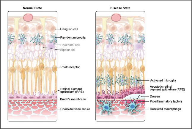 Figure 1. Macrophages are heavily involved in homeostasis and age-related macular degeneration disease progression. In homeostasis, resident microglia and macrophages are phagocytic and clear away extracellular debris and metabolic waste. Immune cells are deterred from encroaching on the RPE and Bruch’s membrane. In a diseased retina, resident microglia and macrophages are recruited to infiltrate up to the retinal pigment epithelium and Bruch’s membrane.