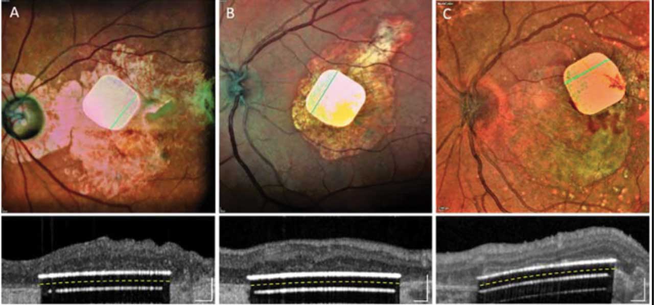 Figure 3. The Prima subretinal implant (Pixium Vision). Top: Fundus photos of the subretinal prosthesis in 3 patients with advanced geographic atrophy. Bottom: Optical coherence tomography images of the same patients demonstrate the placement of the prosthesis under the macula. Reprinted from open-access article: Palanker D, Le Mer Y, Mohand-Said S, Muqit M, Sahel JA. Photovoltaic restoration of central vision in atrophic age-related macular degeneration. Ophthalmology. 2020;127(8):1097-1104.