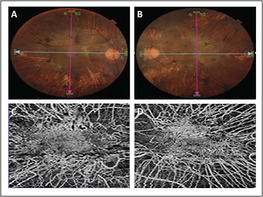 Figure 5. Fundus photography of a case of choroideremia with scattered pigment clumping and visible large choroidal vessels (A, B). Optical coherence tomography angiography images (Triton; Topcon) of choriocapillaris slab show the relatively preserved choriocapillaris at the fovea with grossly deficient choriocapillaris and visible medium and large choroidal vessels in the extrafoveal area (C, D).