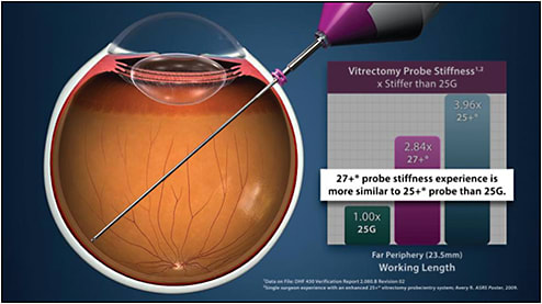 Figure 2. Comparison of vitrectomy probe stiffness for the Constellation platform. Alcon has used materials engineering to enhance vitrectomy probe staff stiffness and, in addition to adding a 1-mm proximal stiffening sleeve, achieves instrument stability closer to the current 25+-gauge technology than the initial Alcon 25-gauge technology. Similar shaft stabilities are observed with instrumentation of the postequatorial retina.