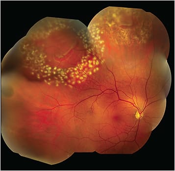 Figure 1. Sequential horseshoe retinal tears treated with laser retinopexy. Composite color fundus photograph from a middle-aged male with a history of RRD in the fellow eye who suffered 3 sequential, symptomatic horseshoe retinal tears over a 2-month period. Shown is an old horseshoe tear at 11:30 with laser scars, another tear at 10:30 with recent laser burns, and a fresh tear without laser at 9 o’clock. See text for more information on the patient’s clinical course.