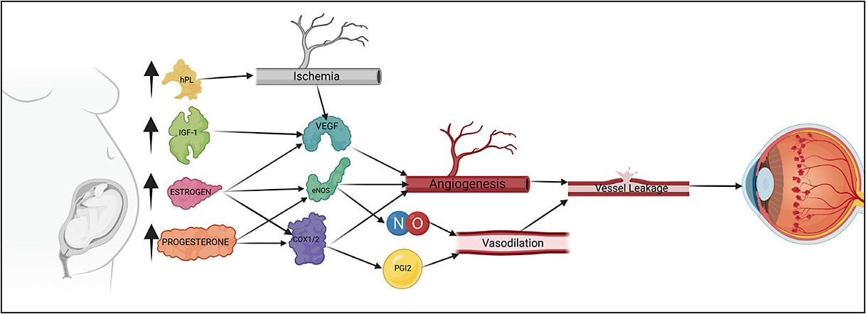 Figure 2. Proposed hormonal mechanisms leading to diabetic retinopathy in pregnancy.