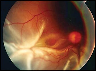 Figure 3. This is a primary inferior rhegmatogenous retinal detachment with PVR, star folds approaching the fovea, and early macular dragging. Primary treatment for this common presentation of PVR is scleral buckle to support the inferior PVR and use of perfluorocarbon liquid with membrane peeling to release the folds and protect the macula. This patient required silicone oil tamponade due to the extensive inferior PVR.