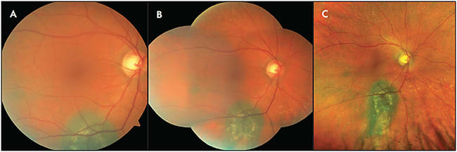 Figure 1. Widefield fundus photography. Standard fundus photos (A) and even a montage image (B) are unable to capture all borders of the choroidal nevus. Widefield images are able to show all margins (C).