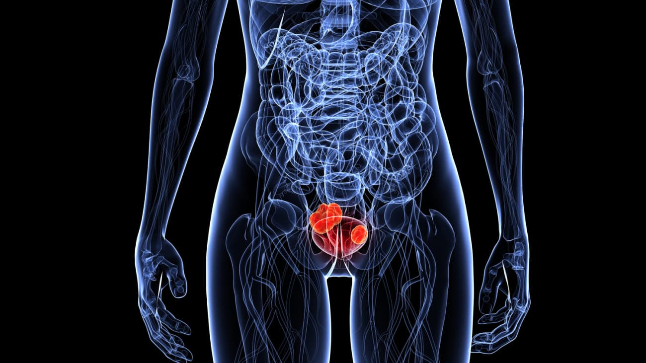 Management of Non-Muscle Invasive Bladder Cancer