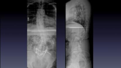 Awake Spinal Surgery Case Study