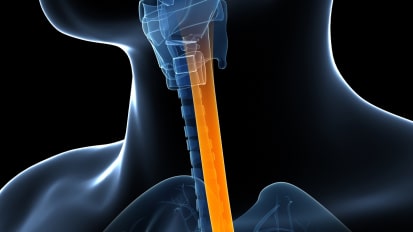 Esophagectomy Patient CareMap