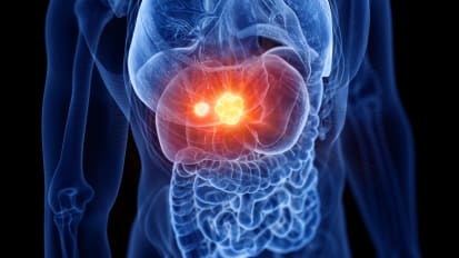 Updates on Colorectal Liver Metastases: A Multidisciplinary Approach