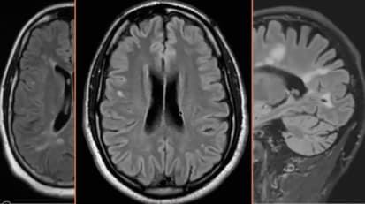 Pediatric Neuroimmunology Update: Pick Up on Common Disorders & Optimize Outcomes
