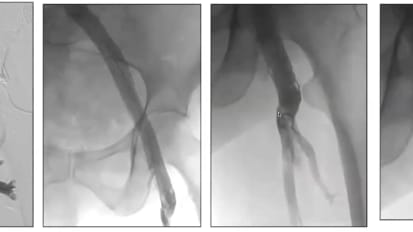 Lecture Video: Optimal Patient Selection for Good Outcomes in Thrombotic Patients (June 11, 2025)