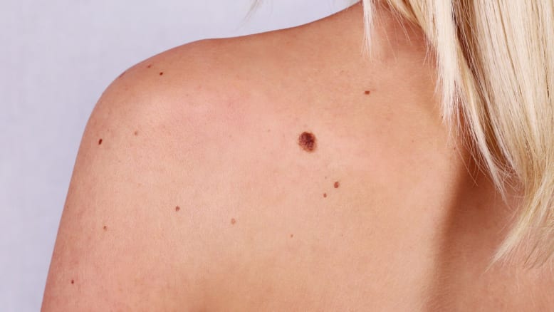 Patient with melanoma cancer