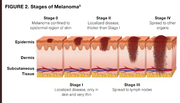 Stages of Melanoma