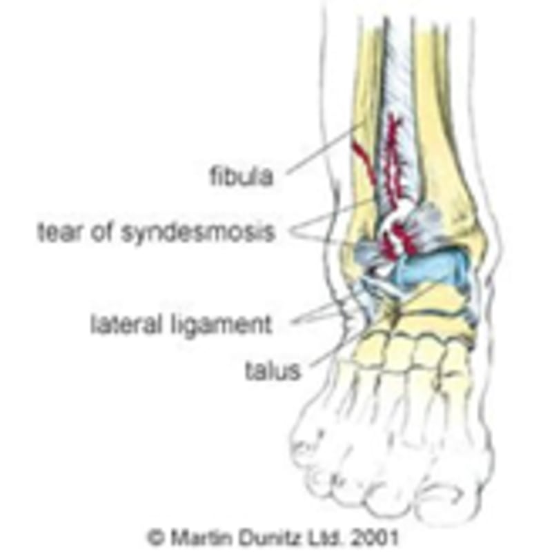 High Ankle Sprain Diagram