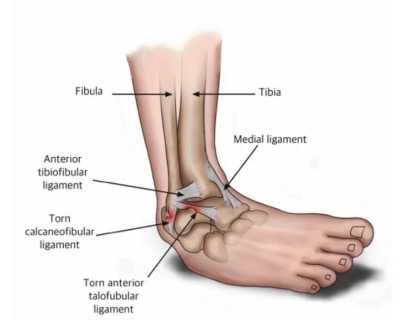 Lateral Ankle Sprain