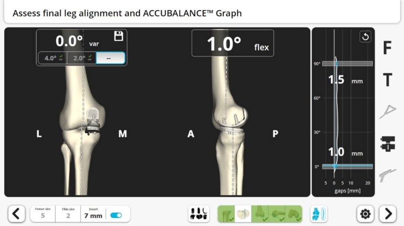 ACCUBALANCE™ Graph for the UKA Procedure 