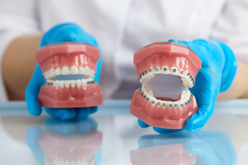 Metal and ceramic braces