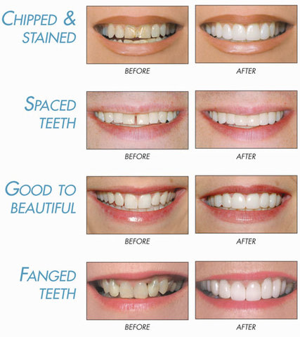 Veneers / Lumineers