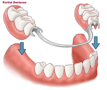 Partial Dentures
