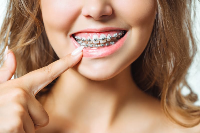 What's it like to get braces?