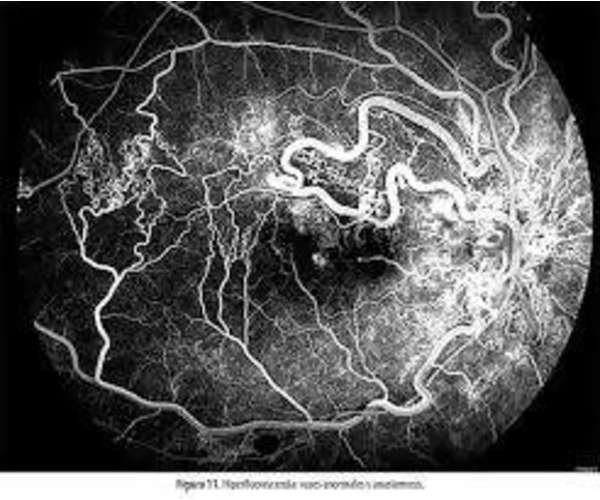 ANGIOFLUORESCEINOGRAFÍA RETINAL