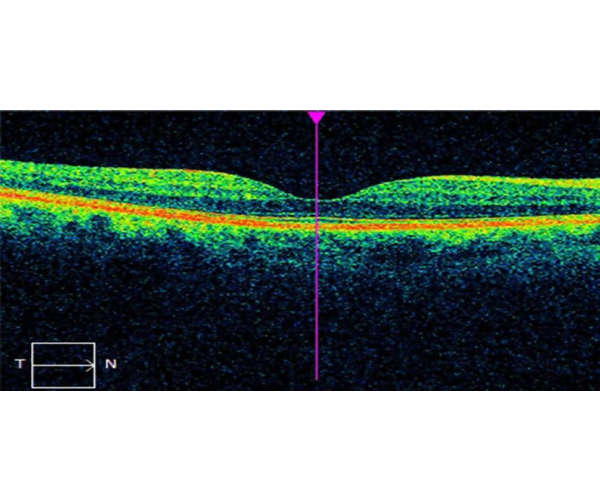 tomografia optica coherente OCT