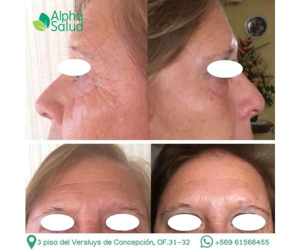 Botox 3 zonas