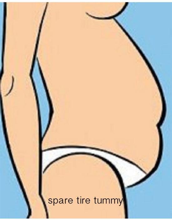 Sometimes this type of abdominal problem is called a spare tire. It's that roll of fat that laps over your belt or the waist of your skirt.