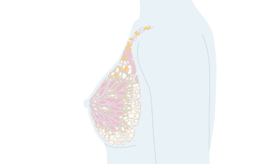 Illustration cancer i bröstet