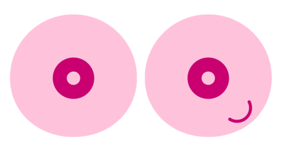 hur känns knöl i bröstet