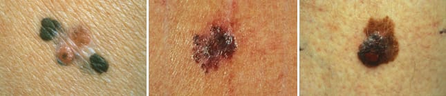 Exempel på tre olika typer av malignt melanom på huden
