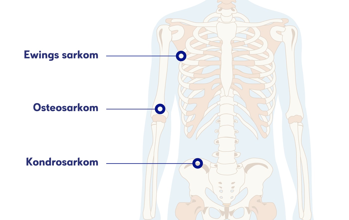 Illustration skelettet, skelettcancer