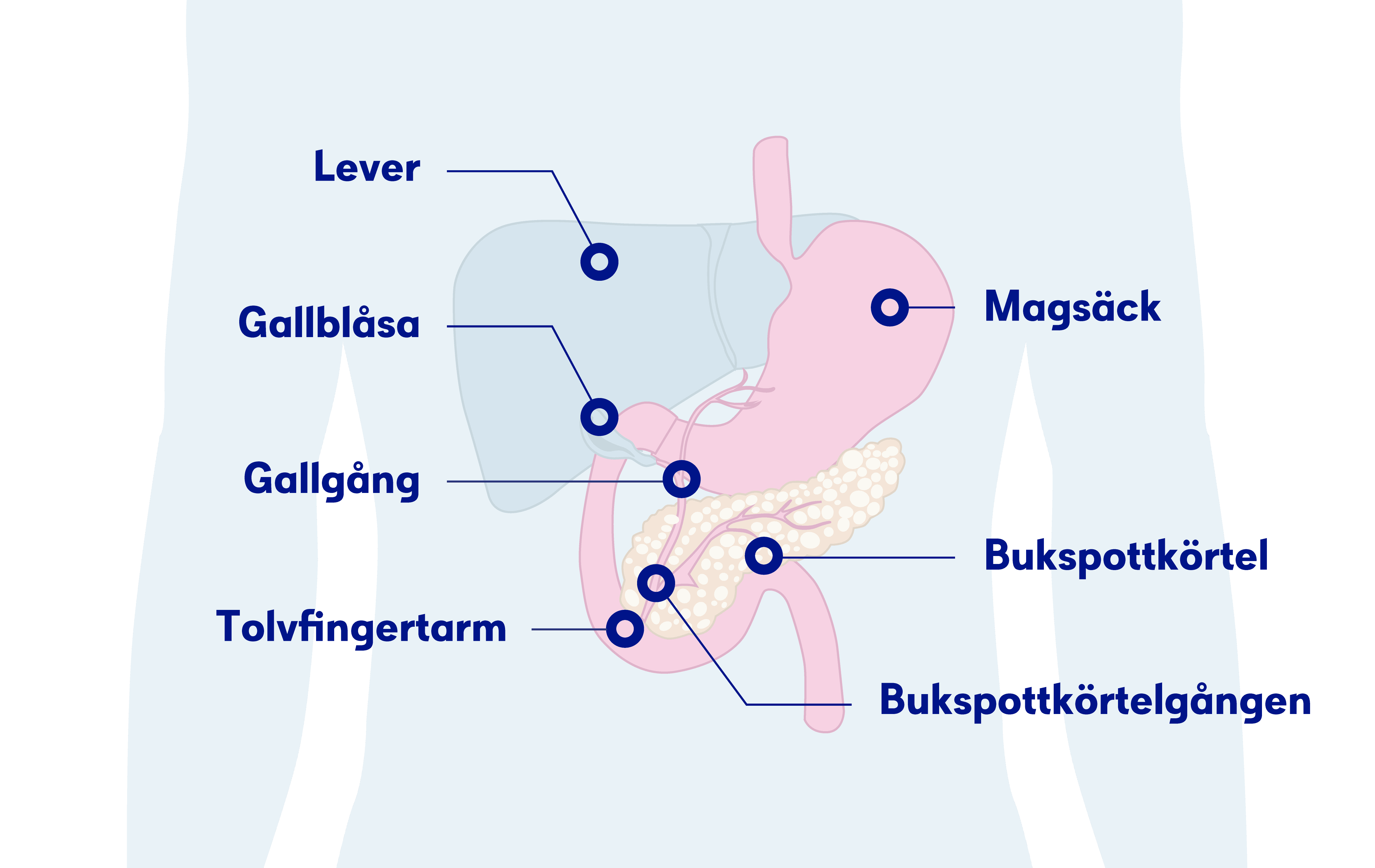 Illustration bukspottkörteln, bukspottkörtelcancer