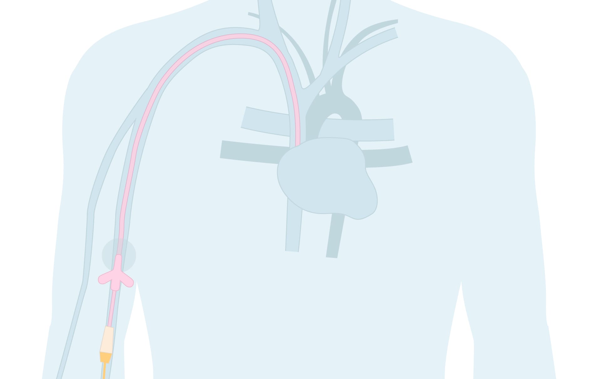 Illustration av picc-line