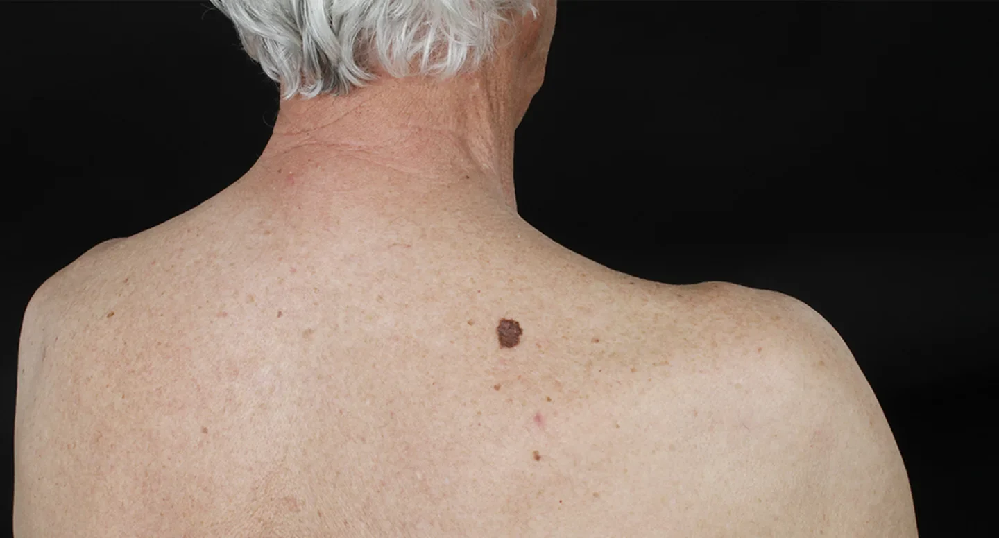 Malignt melanom och ärftlighet | Cancerfonden