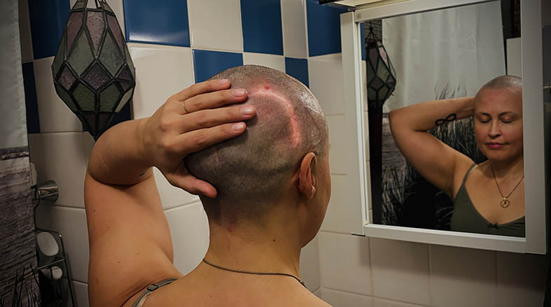 Kvinna med ärr i huvudet efter operation vid en badrumsspegel.